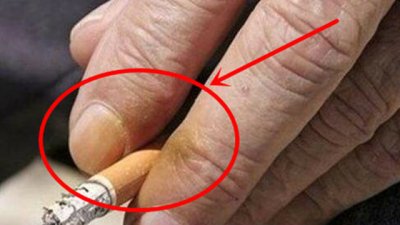 ​怎样才可以防止手指变黄呢
